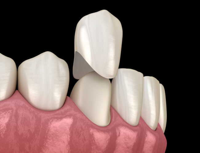 What to Expect from Your Porcelain Crown Procedure in Birmingham, MI Dr. Thomas Coburn Dr. Michelle Sgalia. Birmingham Dental. General, Cosmetic, Restorative, Preventative, Family Dentistry dentist in Birmingham MI 48009