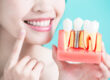Dental Implants in Birmingham, MI Dr. Thomas Coburn Dr. Michelle Sgalia. Birmingham Dental. General, Cosmetic, Restorative, Preventative, Family Dentistry dentist in Birmingham MI 48009