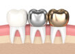 porcelain, titanium, and gold dental crowns When do I need dentures? Dr. Thomas Coburn Dr. Michelle Sgalia. Birmingham Dental. General, Cosmetic, Restorative, Preventative, Family Dentistry dentist in Birmingham MI 48009