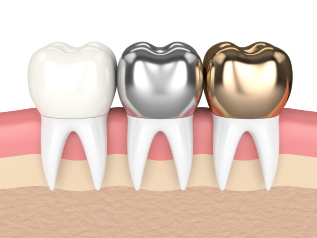 porcelain, titanium, and gold dental crowns When do I need dentures? Dr. Thomas Coburn Dr. Michelle Sgalia. Birmingham Dental. General, Cosmetic, Restorative, Preventative, Family Dentistry dentist in Birmingham MI 48009